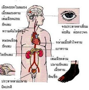 เบาหวานและการรักษา